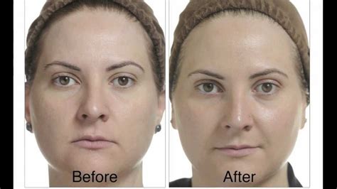 2022 What Happens After A Chemical Peel Youtube