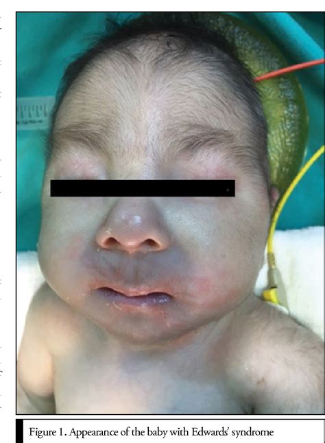 Figure 1 From Anaesthesia Management For Edwards Syndrome Trisomy 18 Semantic Scholar