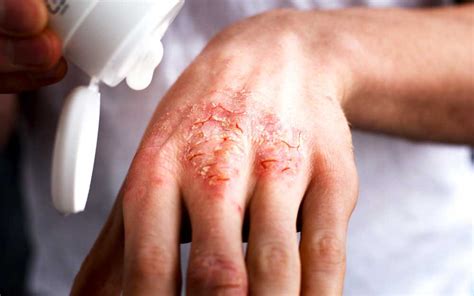 Eczema Causes And How To Get Relief
