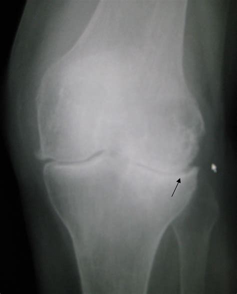 Fileosteoarthritis Left Knee Wikipedia