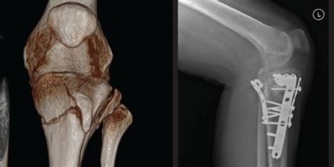 3d Ct Reconstruction Showing Tibial Tuberosity Fracture Open I