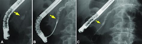 A Ercp Views Showing Impacted Pancreatic Stone Yellow Arrow And