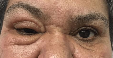 Recurrence Of The Eyelid Edema On The Right Side Download Scientific