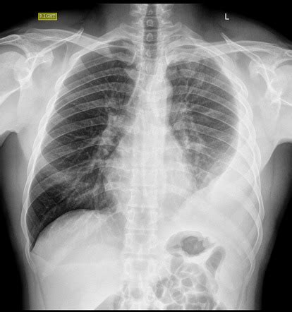 Pleural Effusion Radiology Case Radiopaedia Org