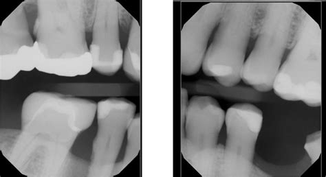 Dental X Rays Why What Kind How Often Dr Danenberg