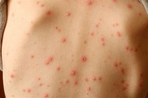 Now you can add one more possibility to the list — a potential coronavirus infection. Skin rash should be considered key symptom of coronavirus, say scientists