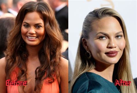 Chrissy Teigen Plastic Surgery Before And After Plastic Surgery
