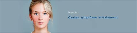 Rosacée Couperose Causes Symptômes Et Traitements Shop Pharmacie