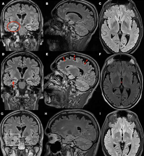 Cerebral Atrophy Causes Symptoms Diagnosis Treatment And Prognosis