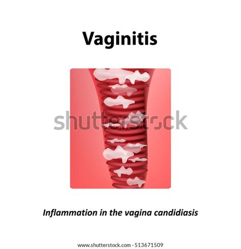 Vaginitis Inflammation Vagina Candidiasis Thrush Infographics Stok