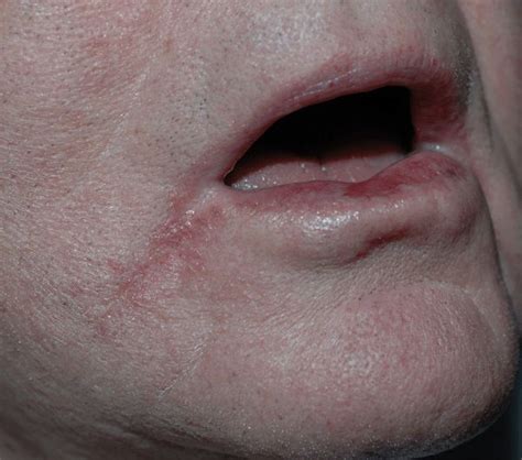 Lips Fungal Infection Pictures