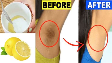 How To Get Rid Of Dark Underarms Overnight Underarms Whitening At Home Youtube
