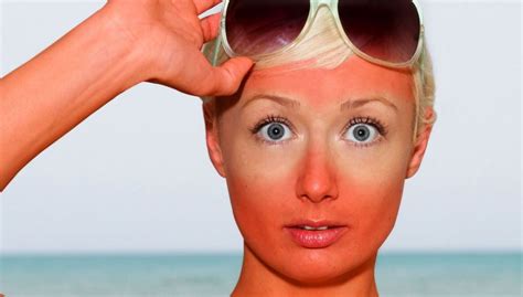 چگونه آفتاب سوختگی را درمان کنیم برای رفع سریع آفتاب سوختگی صورت و