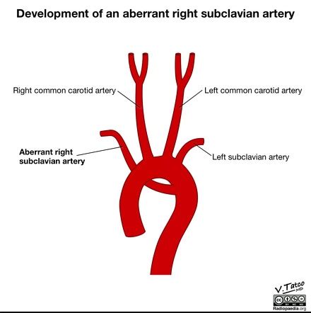Aberrant Right Subclavian Artery Radiology Reference Article
