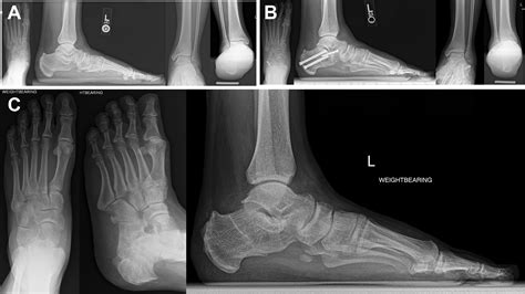 Calcaneal Osteotomies In The Treatment Of Progressive Collapsing Foot