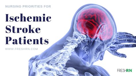 Nursing Priorities For Ischemic Stroke Patients From A Neuro Nurse