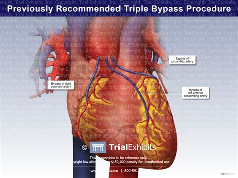 Previously Recommended Triple Bypass Procedure Trialexhibits Inc