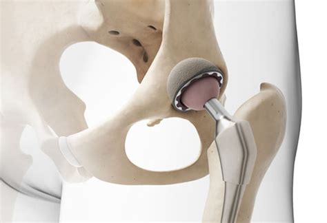 Prótese de Quadril artroplastia de quadril Instituto Trata