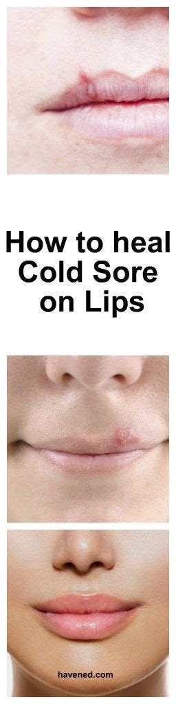 How To Heal Cold Sores On Your Lips Healing Cold Sore Soreness