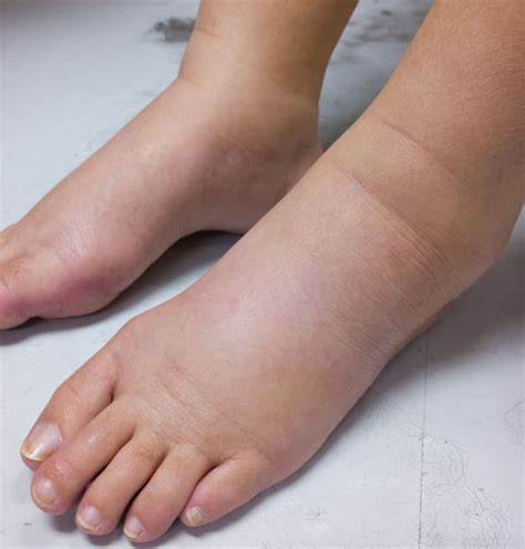 Lower Extremity Lymphedema