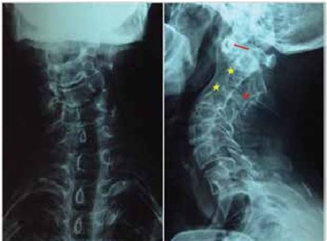 Cervical Spine Radiograph A Ap View Shows Scoliosis Of Cervical Spine