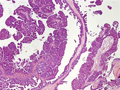 Biopsy Of The Left Ovary Showing High Grade Papillary Serous Carcinoma