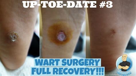 Before And After Fully Healed Plantar Wart Removal Surgery For 7