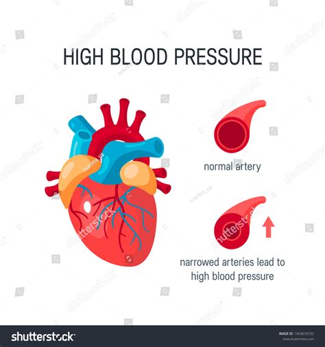 High Blood Pressure Concept Human Heart Stock Vector Royalty Free