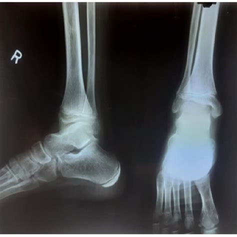 Radiograph Of The Right Ankle Showing An Osteolytic Circular Lesion