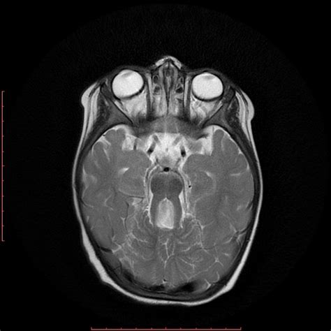 Joubert Syndrome Congenital Vermian Hypoplasia Image