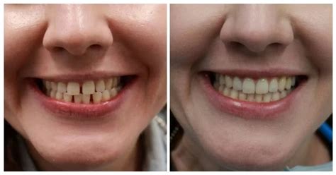 Invisalign Dentist Clear Braces That Look Great Free Consult South