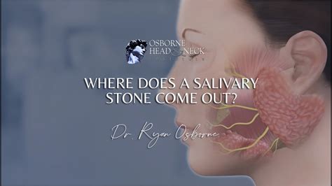 Where Does A Salivary Stone Come Out Youtube