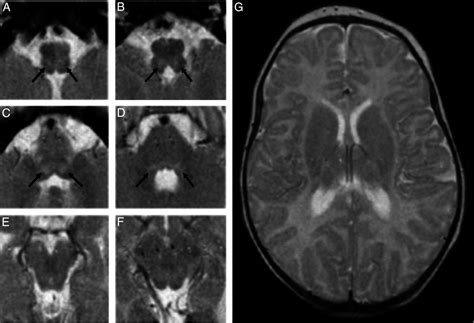 Dorsal Brain Stem Syndrome Mr Imaging Location Of Brain Stem Tegmental