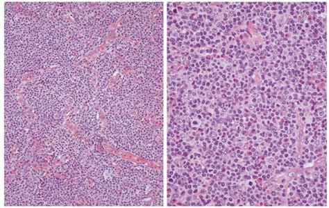 The median survival period is reported to be between 1 to 2.5 years. Angioimmunoblastic T-Cell Lymphoma: an Epstein-Barr Virus ...