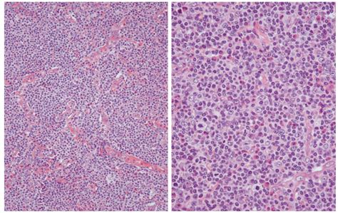 1,2 cutaneous lesions may manifest as a pruritic. Angioimmunoblastic T-Cell Lymphoma: an Epstein-Barr Virus ...