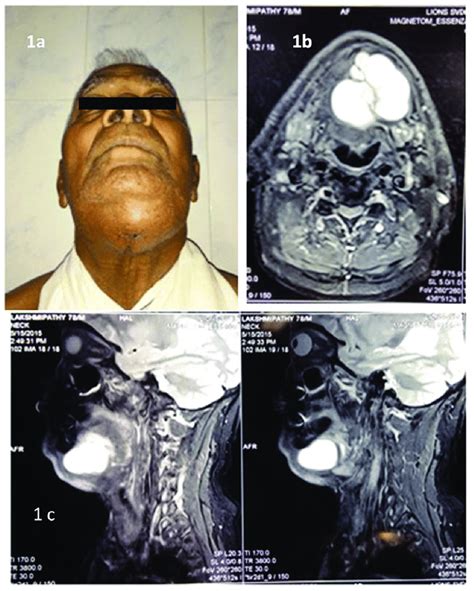 A Extraoral View Showing Swelling In The Submental Region Extending