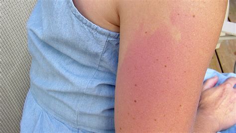 Summer Skin Rashes What You Should Know Beaumont Health