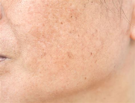 White Spots On Face Causes Of Child Small Patches Vitamin