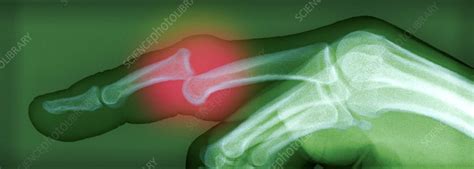 Dislocated Finger Stock Image M3301023 Science Photo Library