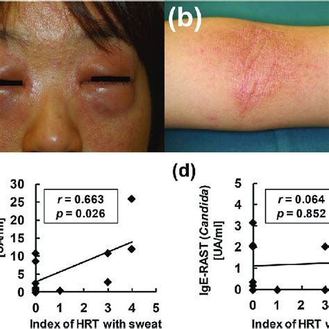 Clinical Characteristics Of Patients With Cholinergic Urticaria With