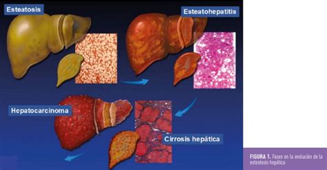 Esteatosis hepática no alcohólica en Diabetes tipo 1 Revista Diabetes
