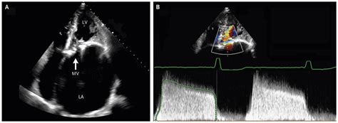 Severe Mitral Stenosis The Physical Examination Revealed Grepmed