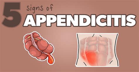 5 Appendicitis Signs You Dont Want To Miss Health And Willness