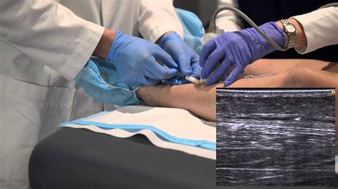 ivs ultrasound guided sclerotherapy youtube