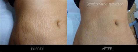 Stretch Mark Removal Laser Costs Core Plastic Surgery