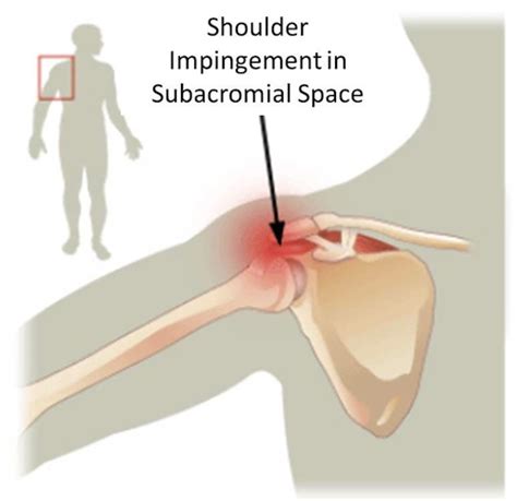 While shoulder impingement can be painful and affect your daily activities, most people make a full recovery within a few months. 3 Essential Exercises to Prevent Shoulder Pain ...