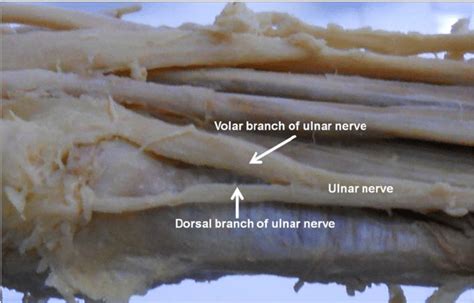 The Dorsal Branch Of The Ulnar Nerve Arising In The Distal Third Of
