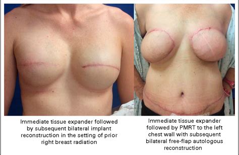 Double Mastectomy With Immediate Reconstruction