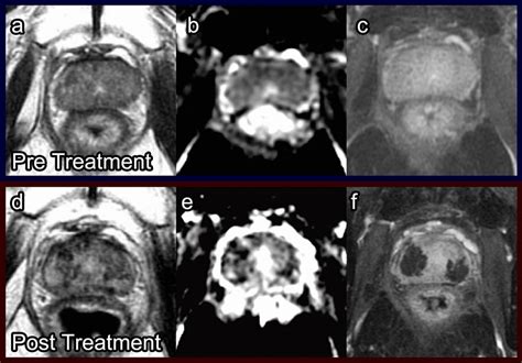 Photodynamic therapy. Pretreatment prostate MRI in a patient with