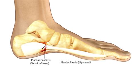 What Is Plantar Fasciitis Plantar Fasciitis Treatments You Can Do At